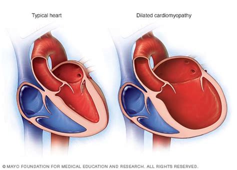 stages of dilated cardiomyopathy